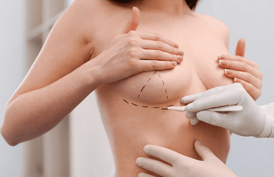 Хөх имплантаар томруулах мэс засал Breast augmentation surgery