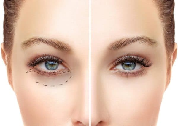 Lumi Eyes Eyelid Injection